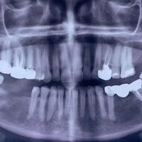 Défauts osseux autour des dents