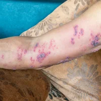 Infections nécrosantes de la peau 