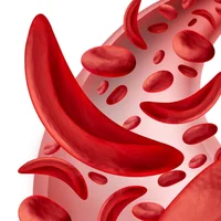 drepanocytose-hemoglobinose-s