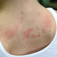 Eczéma allergique