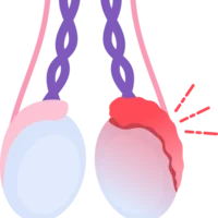 Épididymite et orchiépididymite