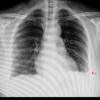 Fibrose et calcification pleurales