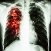 Fibrose pulmonaire