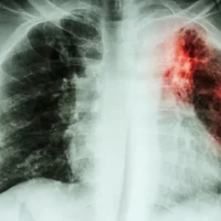 Fibrose pulmonaire idiopathique 