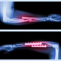 Fractures osseuses