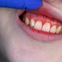 problemes-de-gencives-et-de-support-dentaire
