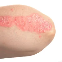 Psoriasis